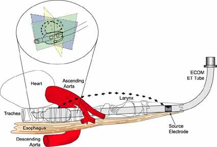 Diagram of a heart and ascending aorta