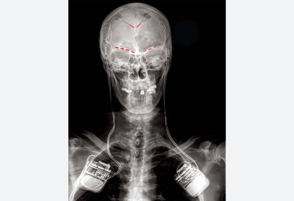 Chronic pain brain mapping x-ray.