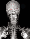 Frontal x-ray image of one study participant showing implanted brain recording electrodes (in red) connected to a bidirectional brain stimulating and recording implant on both sides of the body. 